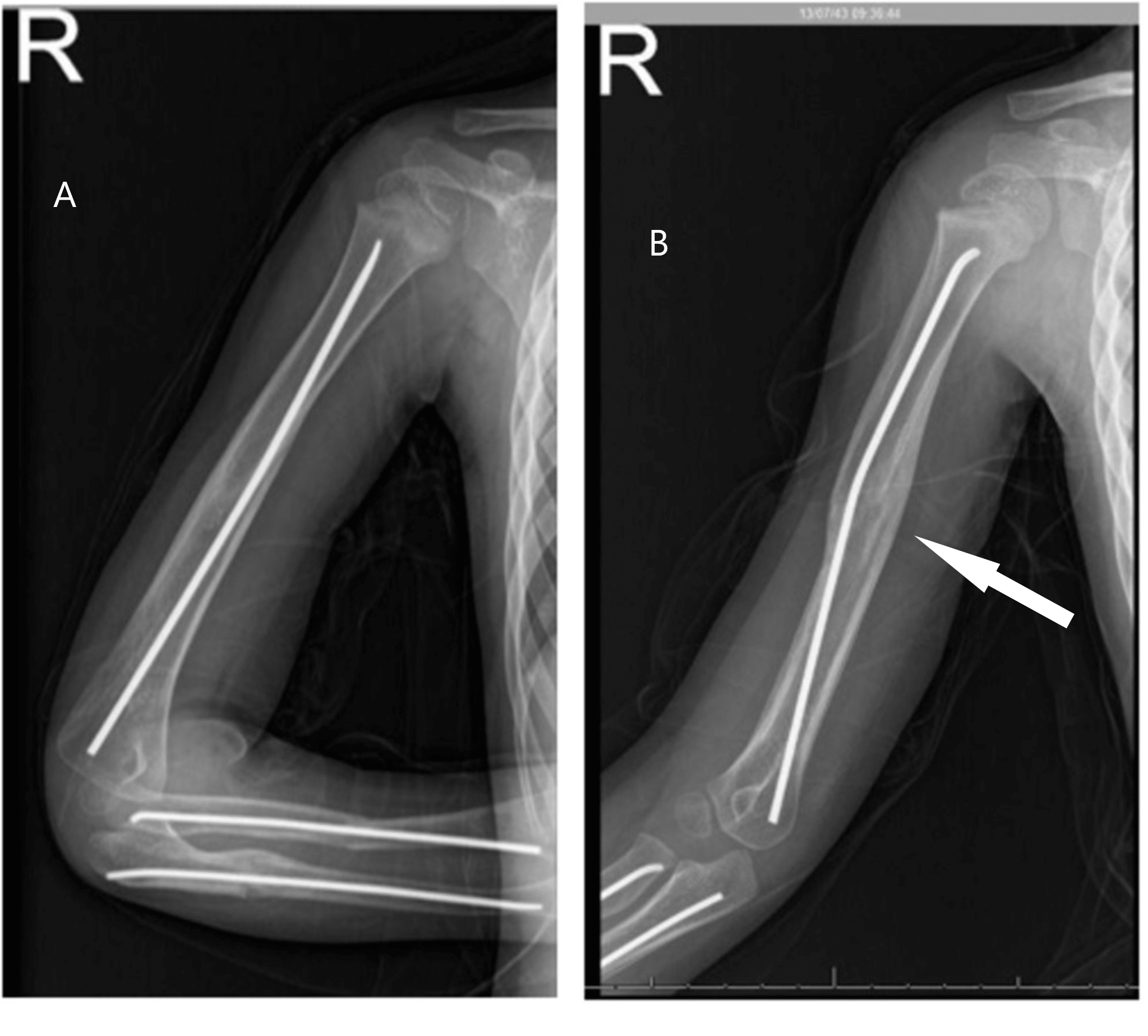Cureus Pediatric Floating Elbow Caused by a Novel Mechanism A Case