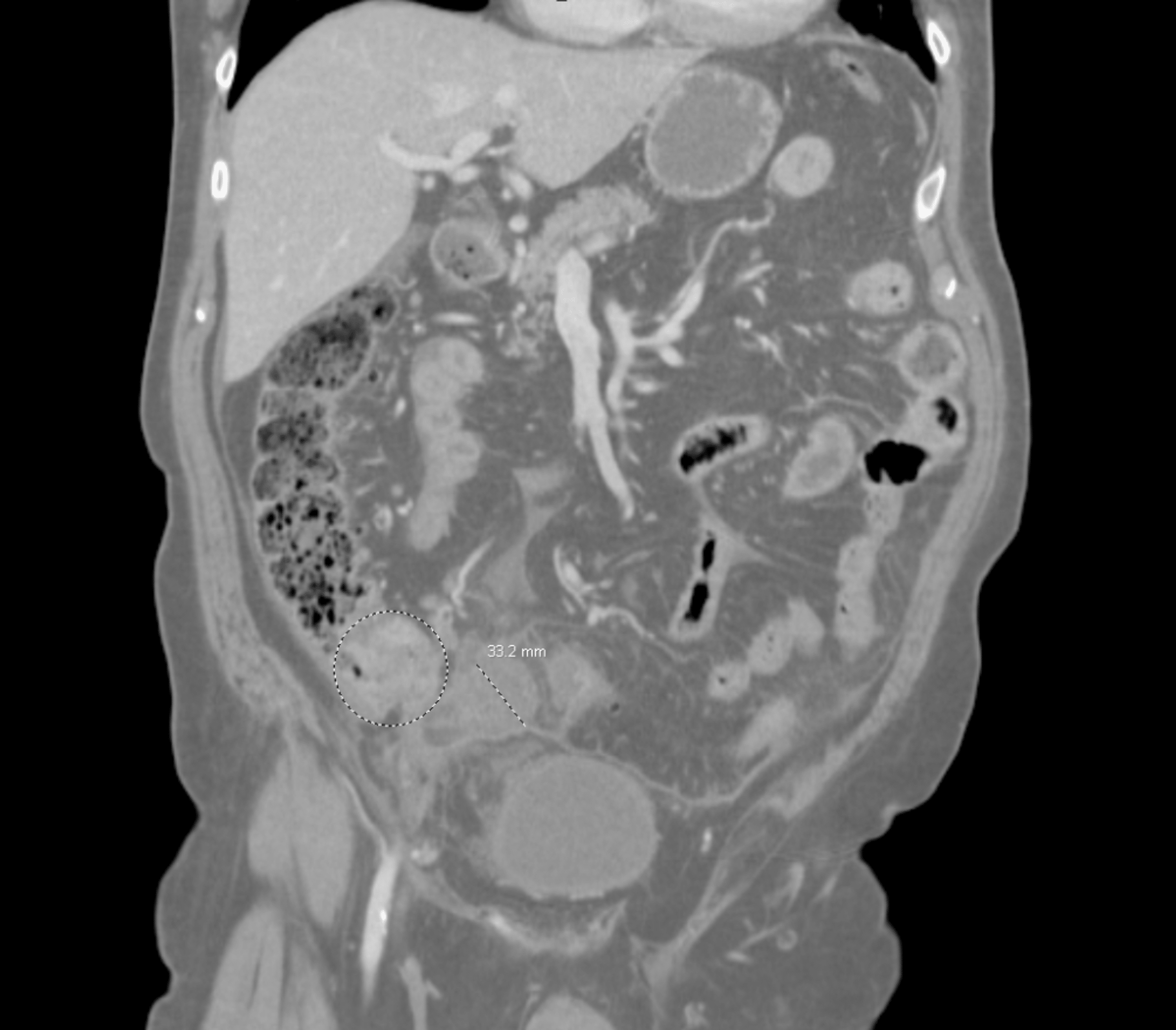 Cureus | Appendicitis Secondary to Obstructing Ascending Colon Malignancy