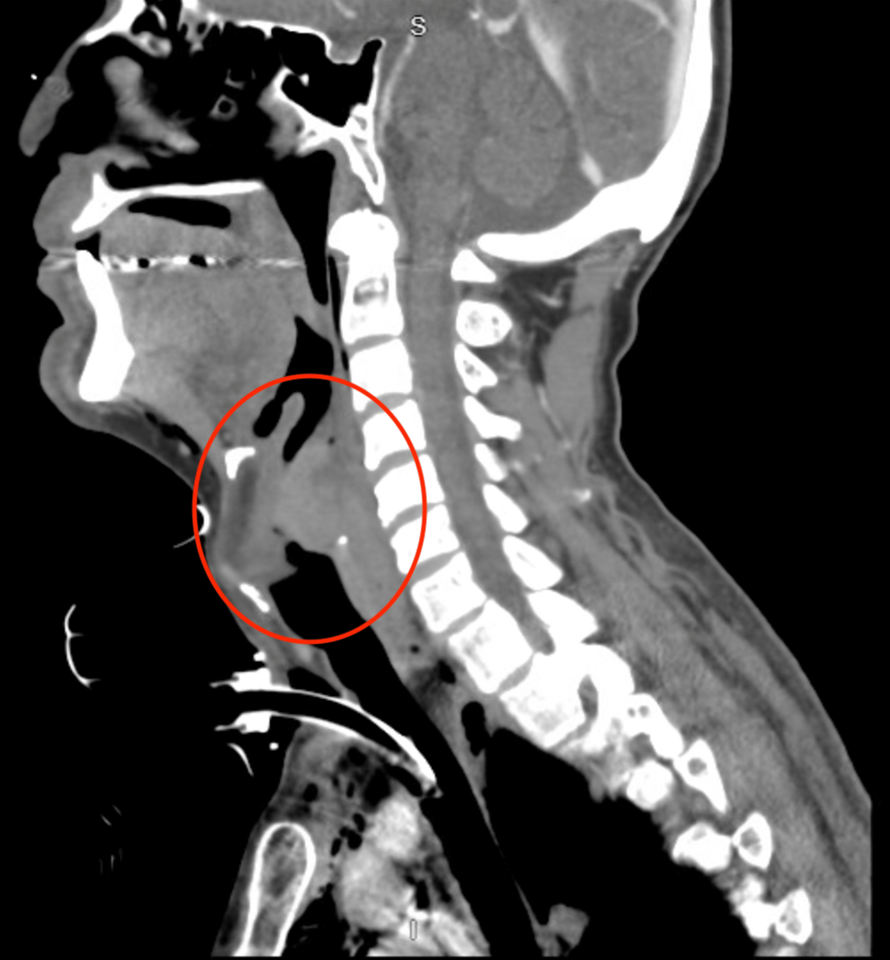 Cureus Isolated Percutaneous Endoscopic Gastrostomy Site Metastasis