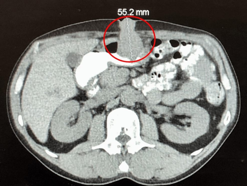 Cureus Isolated Percutaneous Endoscopic Gastrostomy Site Metastasis