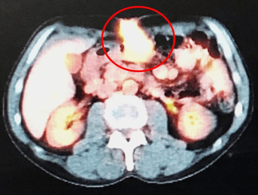 Cureus Isolated Percutaneous Endoscopic Gastrostomy Site Metastasis