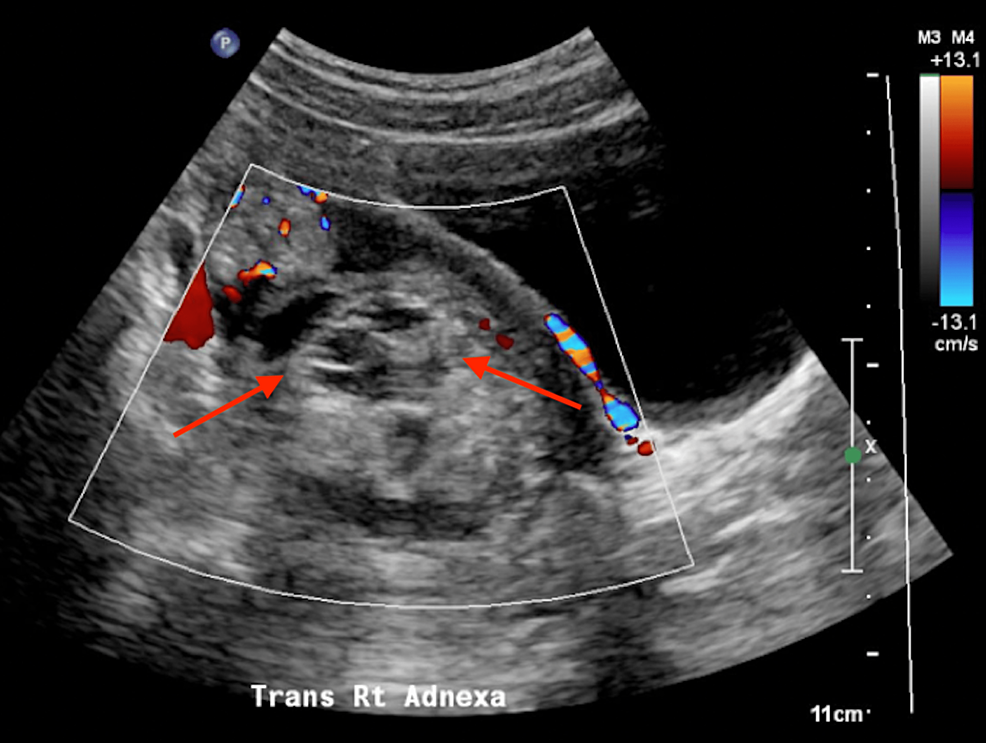 Transverse-view-of-the-pelvic-ultrasound-showing-the-heterogeneously-echogenic-region-(red-arrows)-within-the-right-adnexa-without-internal-vascular-flow.