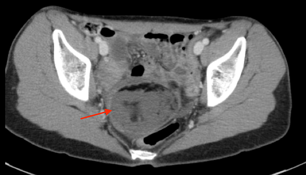 Axial-view-of-the-CT-abdomen/pelvis-showing-the-complex-mass-(red-arrow).