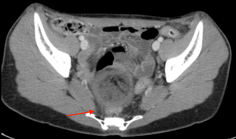 Axial-view-of-the-CT-abdomen/pelvis-showing-distended-loops-of-the-bowel-with-compression-of-the-bowel-within-the-sigmoid-colon-(red-arrow).