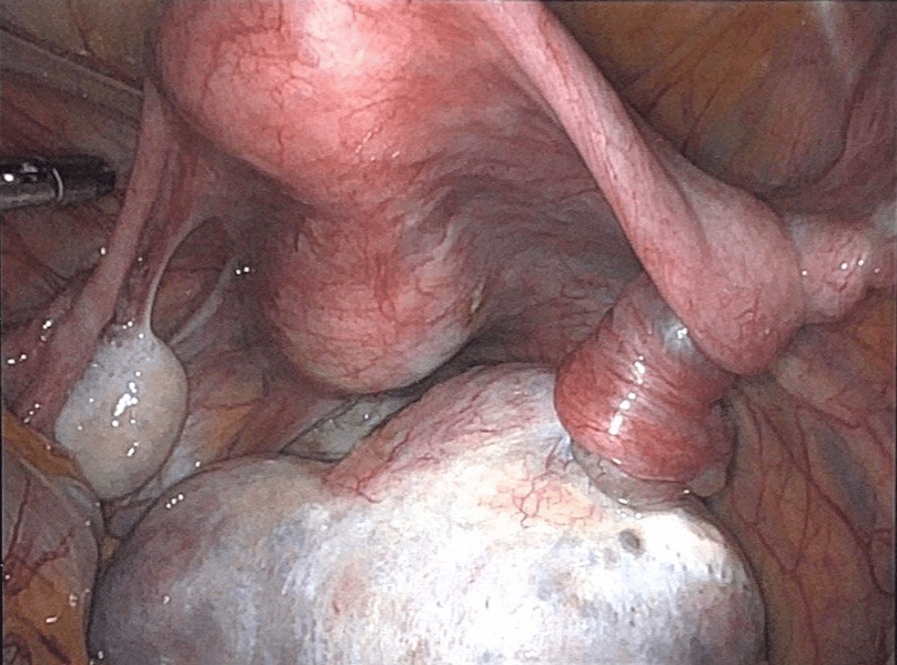 Anterior-view-of-cystic-teratoma-and-the-resultant-right-adnexal-torsion.