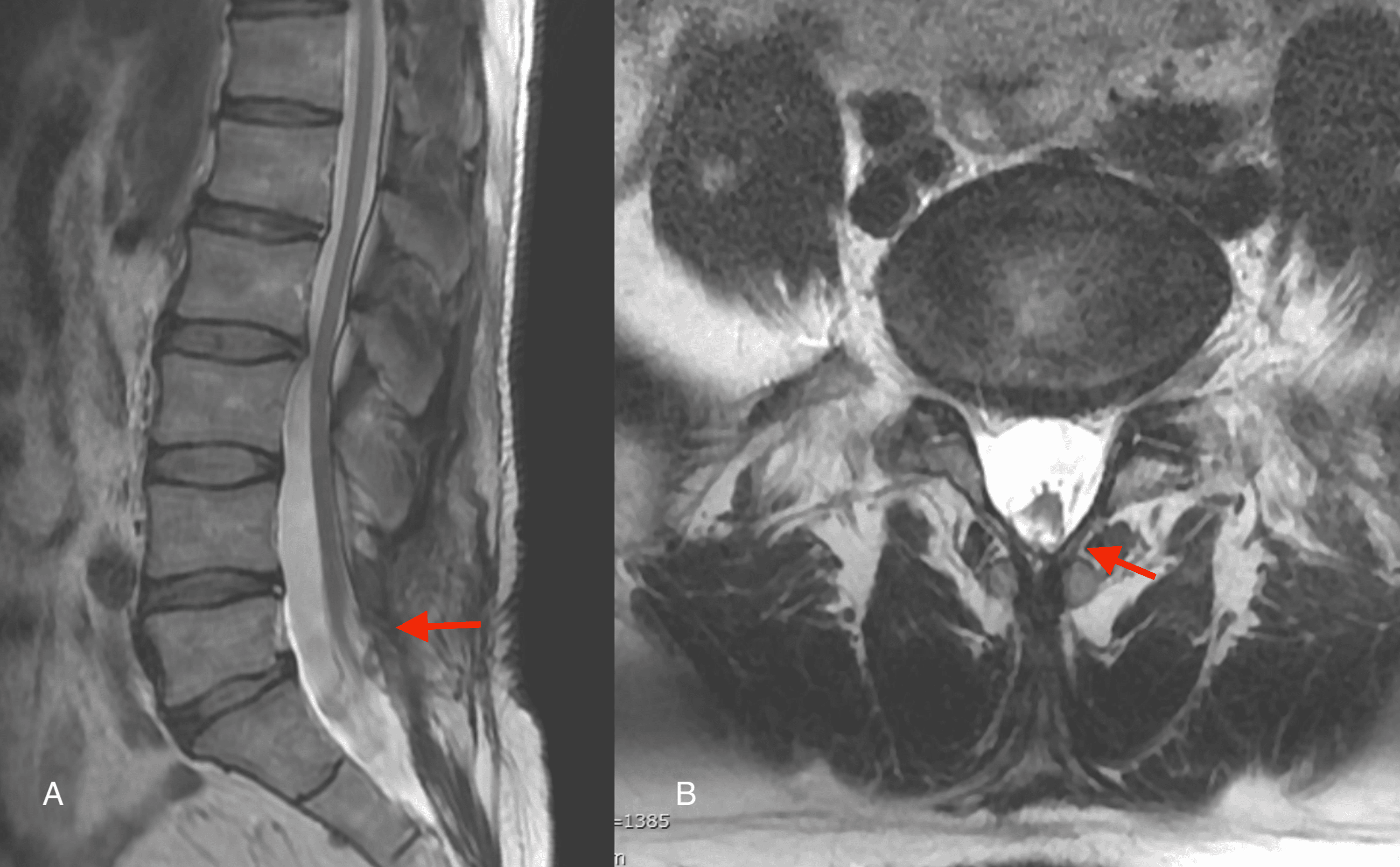 Cureus FullEndoscopic Discectomy in an Adult Postoperative Spinal