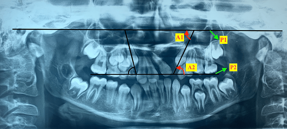 kumar-and-daigavane-s-impacted-maxillary-canine-grading-system-a-new