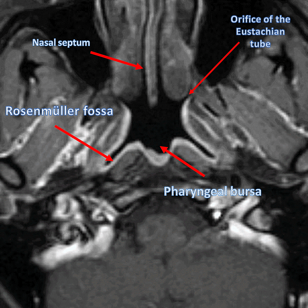 Magnetic-resonance-imaging-of-a-healthy-subject,-highlighting-certain-portions-of-the-nasopharynx,-such-as-the-orifice-of-the-Eustachian-tube,-the-pharyngeal-bursa,-and-the-Rosenmüller-fossa,-and-the-nasal-septum-(slightly-deviated)