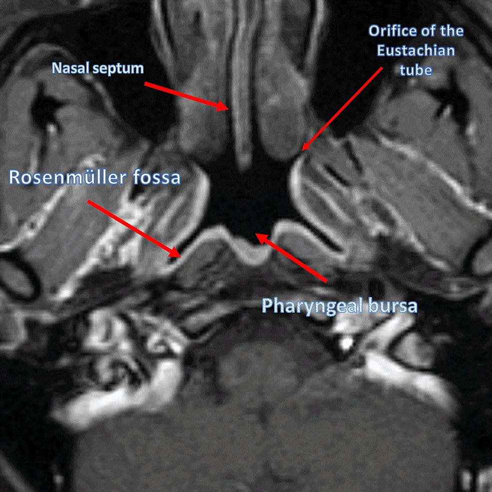 Neonatal characteristics in OSA and non-OSA groups.