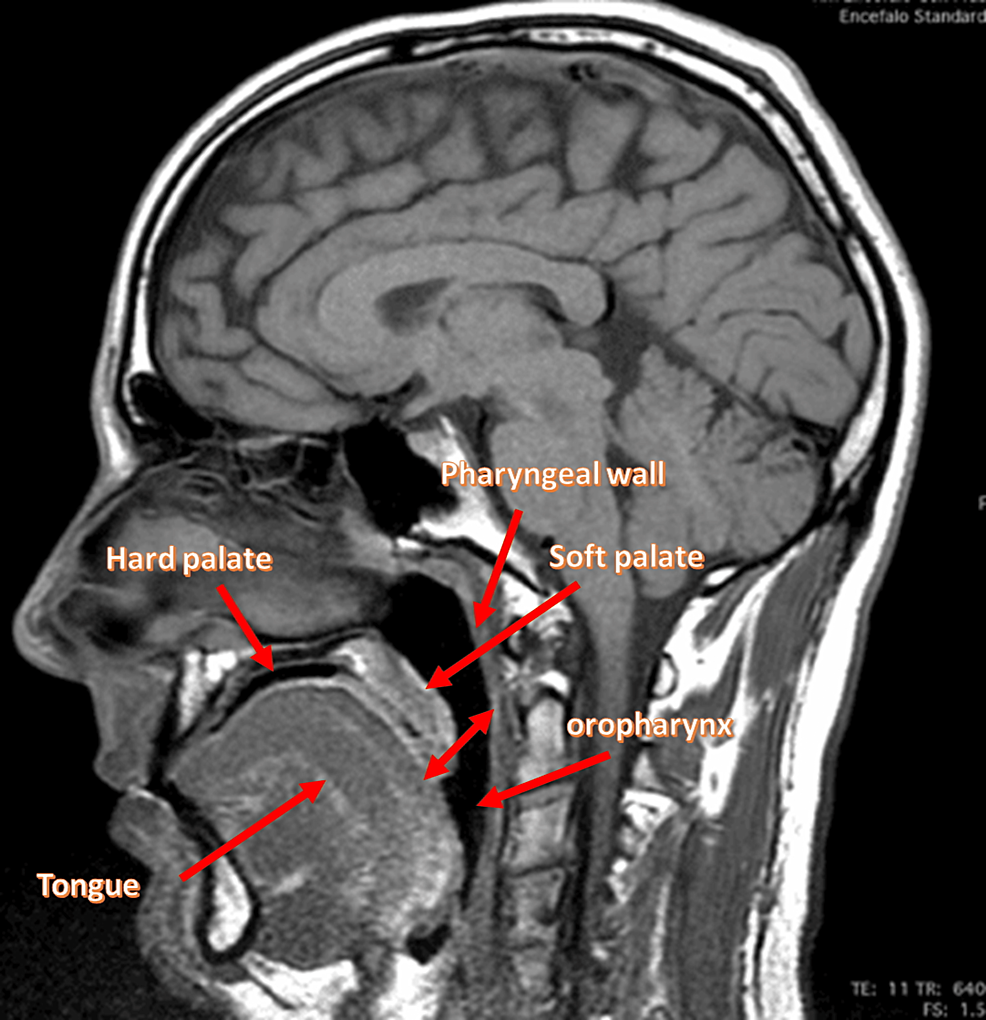 The-magnetic-resonance-image-highlights-some-anatomical-components-of-a-healthy-person:-the-oropharynx;-pharyngeal-wall;-tongue;-soft-palate-(the-double-headed-arrow-recalls-the-movement-of-the-soft-palate);-and-the-hard-palate