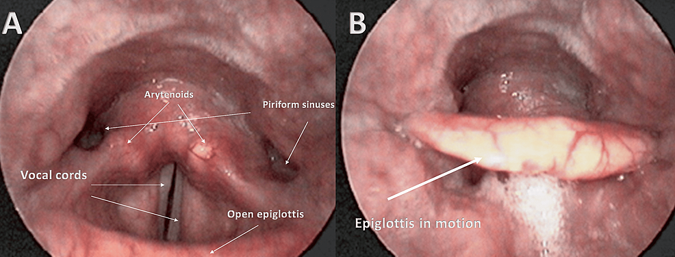 Photo-A-shows,-through-a-fibrolaryngoscopy-examination,-the-laryngeal-area-and-some-of-its-anatomical-components;-photo-B-shows-the-same-area-but-with-the-epiglottitis-toward-the-closure-phase