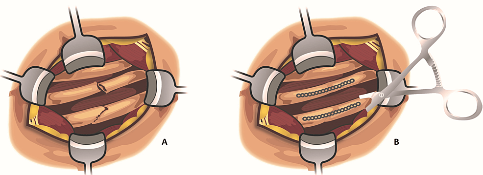 Illustrations-displaying-multiple-rib-fractures-before-(A)-and-after-surgical-stabilization-with-plating-application-(B).