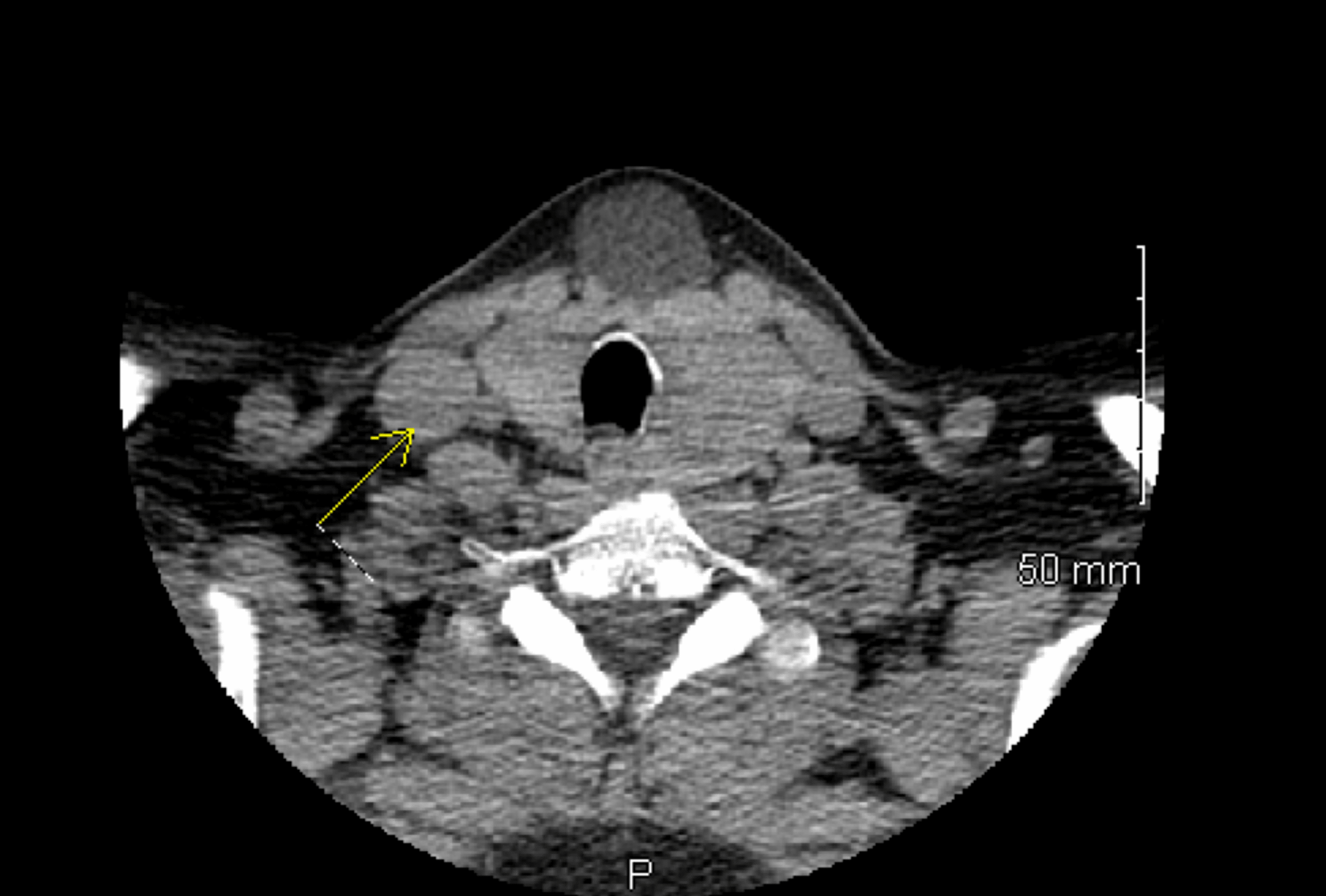 Cureus Atypical Presentation Of Epidermoid Inclusion Cyst In A 60 Year Old Female A Case Report 6540