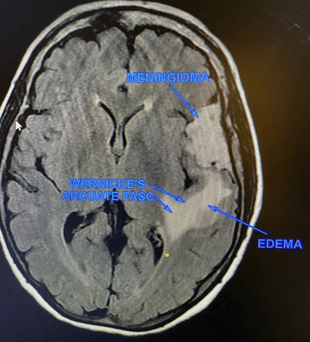 Cureus Acute Onset Of Movement Disorders Accompanying Common