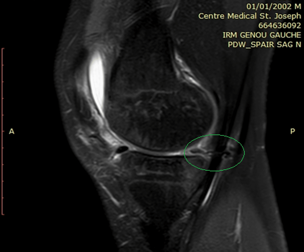 MRI-of-the-left-knee-showing-entrapment-of-semimembranosus-tendon-by-medial-meniscal-suture