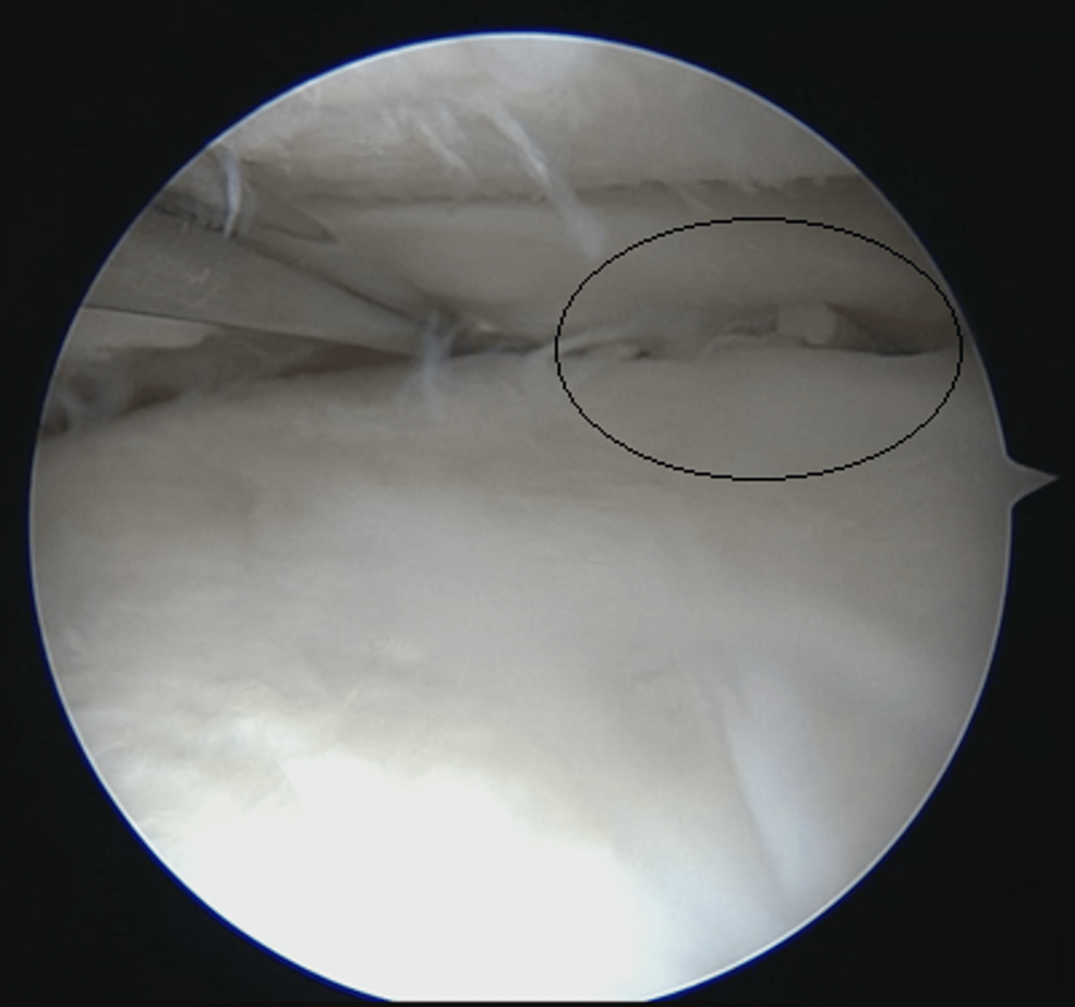 Medial-meniscus-suture-and-complete-healing-of-medial-meniscal-lesion-seen-during-left-knee-arthroscopy