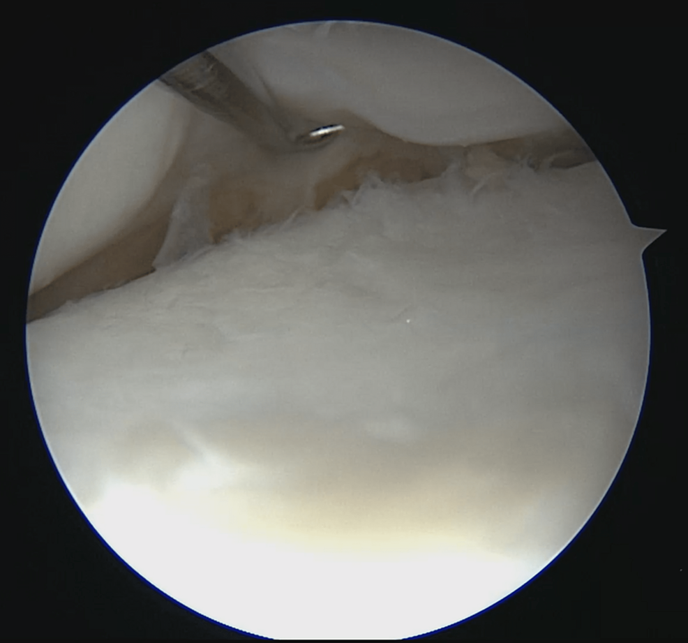Left-medial-meniscus-after-releasing-most-medial-suture-showing-complete-healing