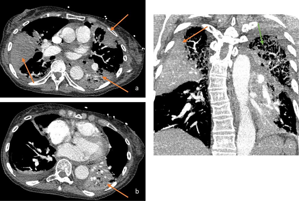 Transverse-(a,-b)-and-Coronal-(c)-Views-of-a-Computed-Tomography-Angiography-Scan-of-the-Chest.