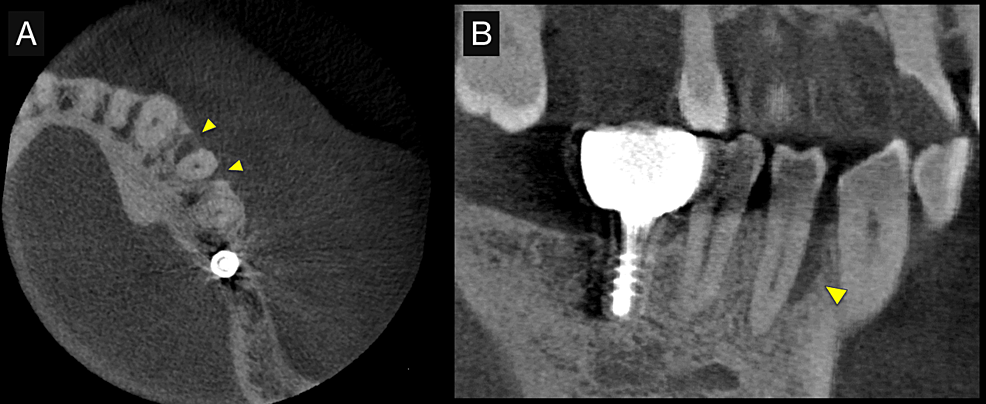 Preoperative-cone-beam-computed-tomography-(CBCT)-images.