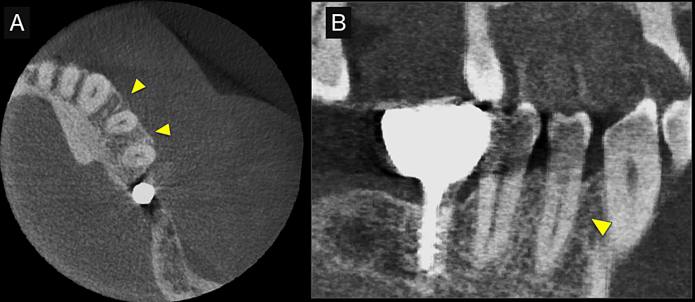 Postoperative-cone-beam-computed-tomography-(CBCT)-images.