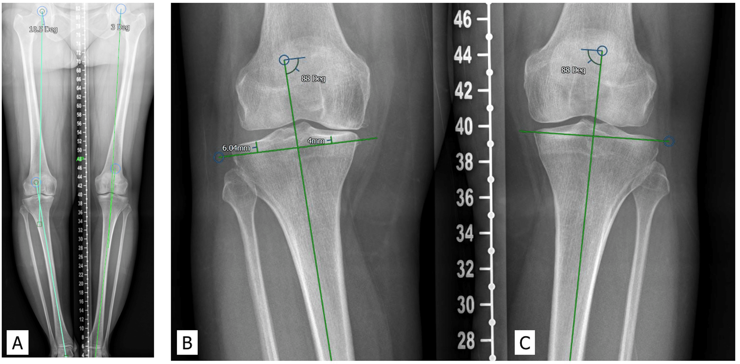 Cureus Mechanical Alignment in Total Knee Arthroplasty for Varus Knee Osteoarthritis Leads to