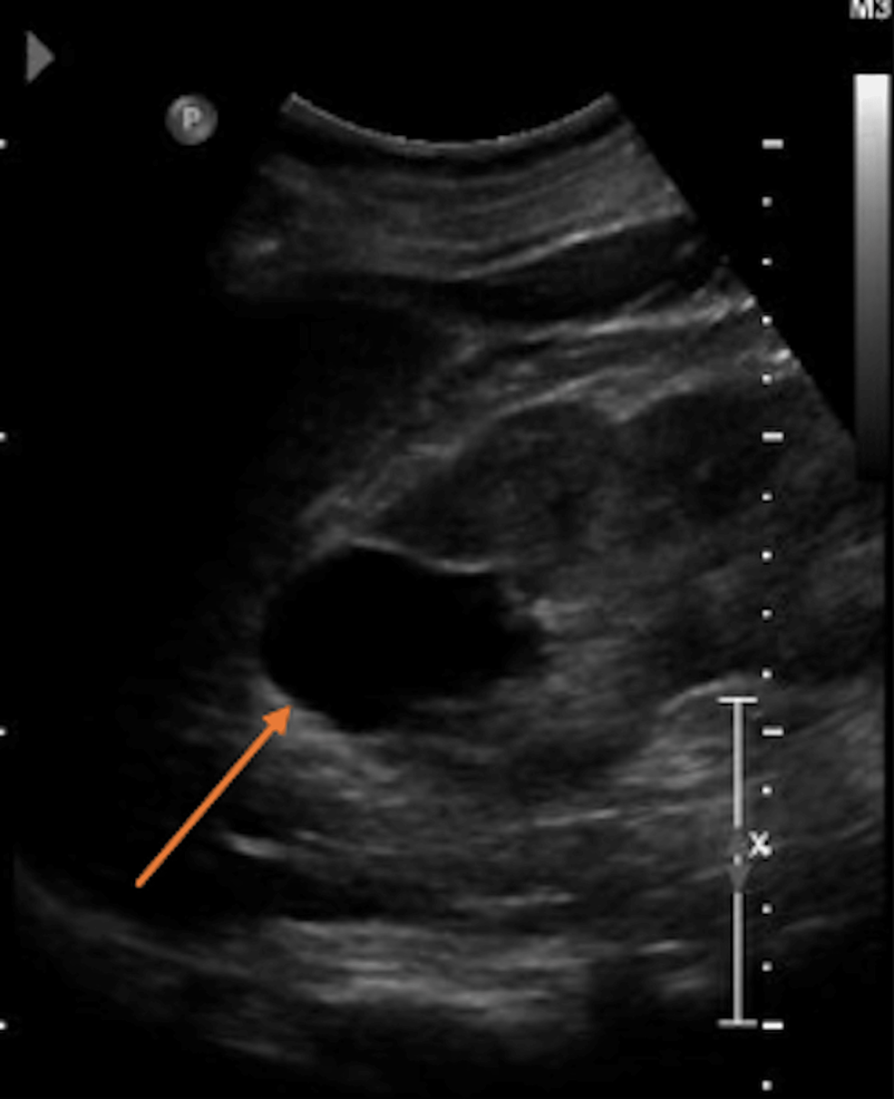 Cureus BirtHoggDubé Syndrome Two Patients With Different Initial