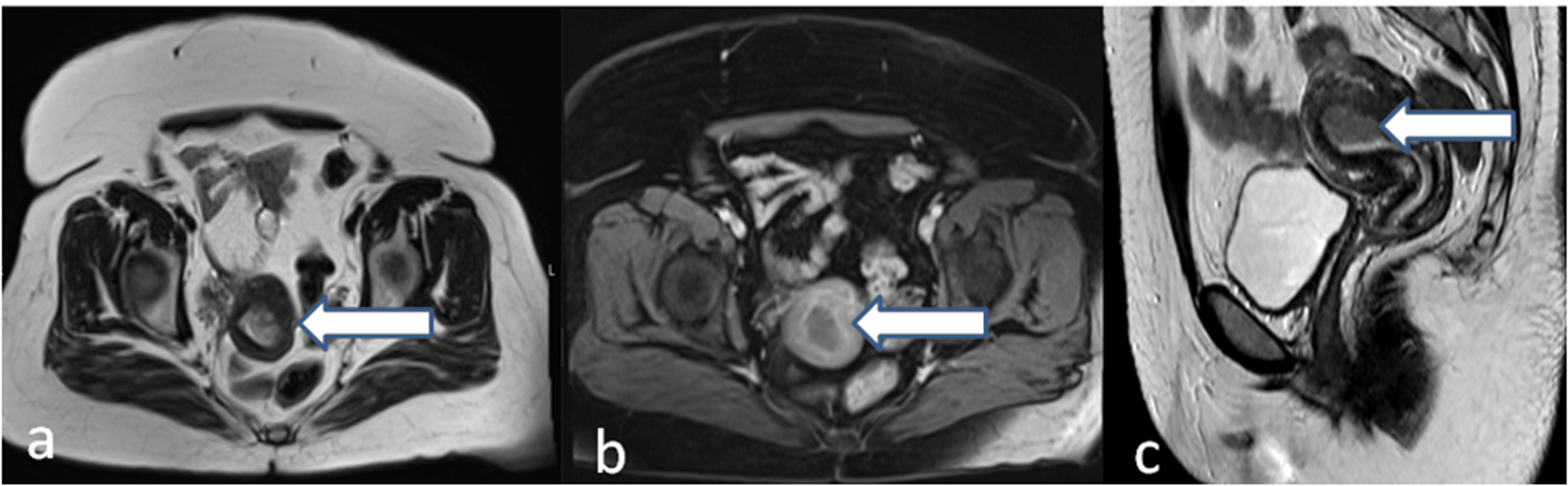 Cureus The Accuracy of MRI in the Local Staging of Endometrial Cancer