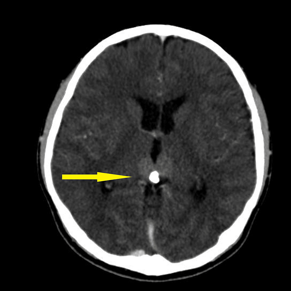 CT-brain-axial-showing-hyperdense-lesion-in-the-pineal-gland-region-measuring-2.2-cm-x-2.6-cm-x-1.8-cm-(yellow-arrow).