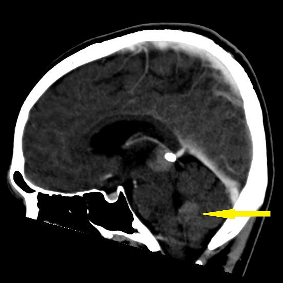 CT-brain-sagittal-showing-hypodense-lesion-in-the-right-lateral-and-posterior-wall-of-the-fourth-ventricle-measuring-2.1-cm-x-3.3-cm-x-2.2-cm-(yellow-arrow)