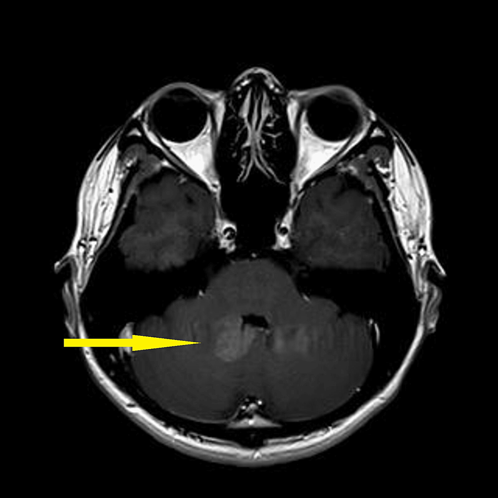 Enhanced-MRI-brain-(T1)-axial-post-contrast-showing-an-ill-defined-lesion-in-the-fourth-ventricle-(yellow-arrow)
