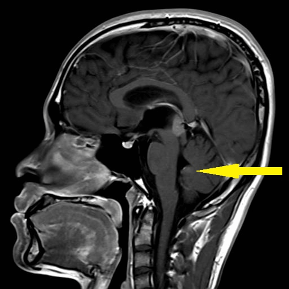 MRI-brain-(T1)-sagittal-showing-an-ill-defined-lesion-measuring-2.1-cm-x-2.1-cm-x-1.7-cm-(yellow-arrow)