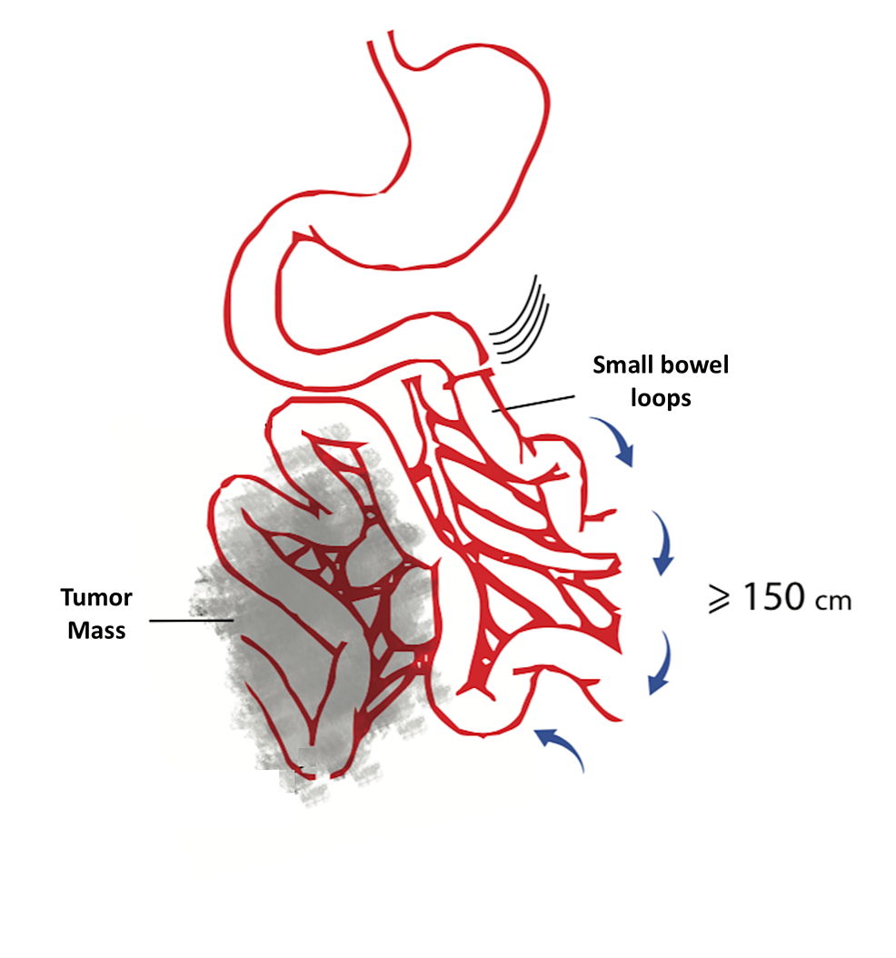 Cureus SpiliotisFarfarelos Maneuver for the Management of Small
