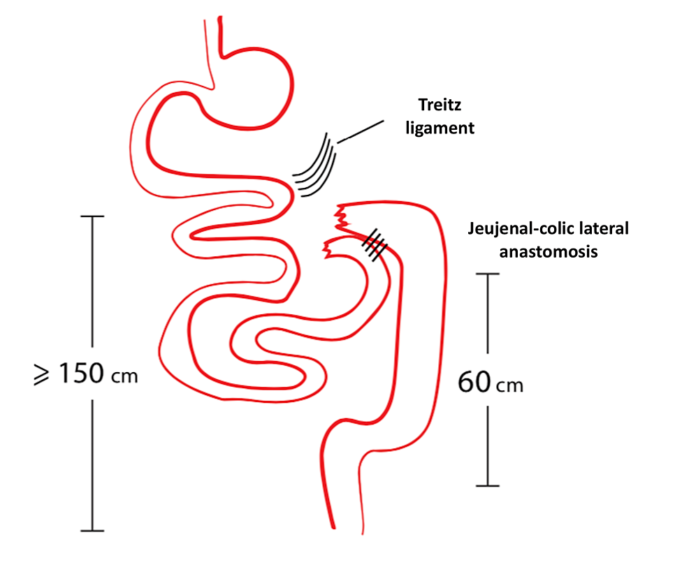 Cureus SpiliotisFarfarelos Maneuver for the Management of Small