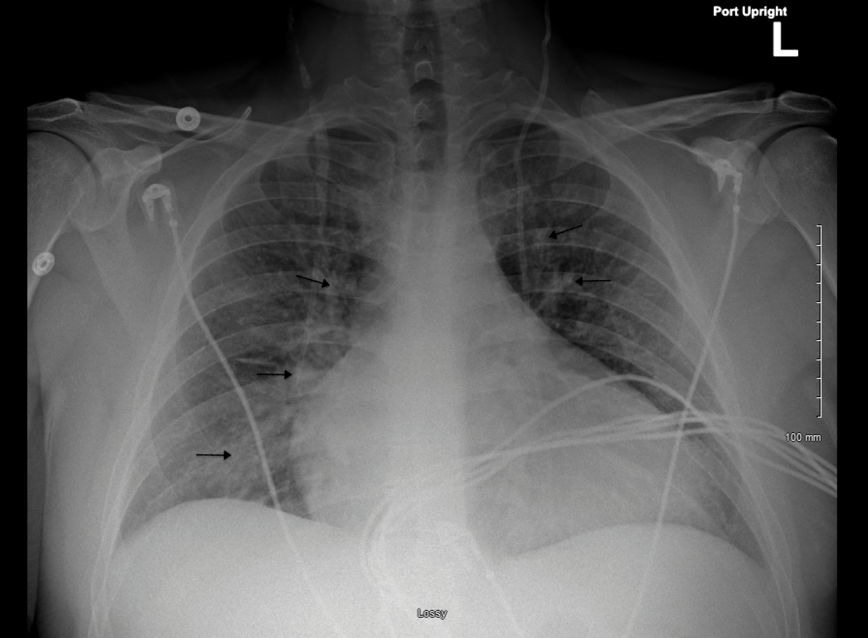 Cureus Left Ventricular in a 40YearOld Male With