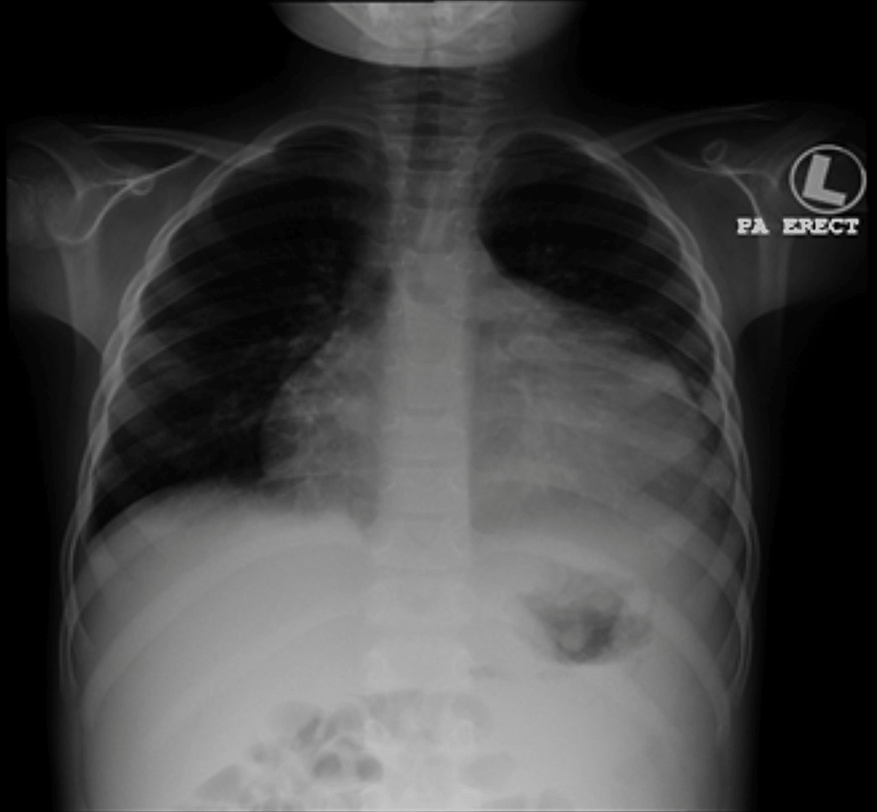 Chest-X-ray-showing-cardiomegaly