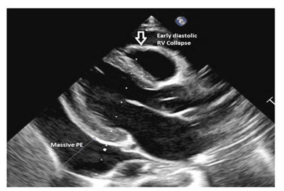 Initial-echocardiography-showing-massive-pericardial-effusion-and-early-diastolic-right-ventricular-collapse