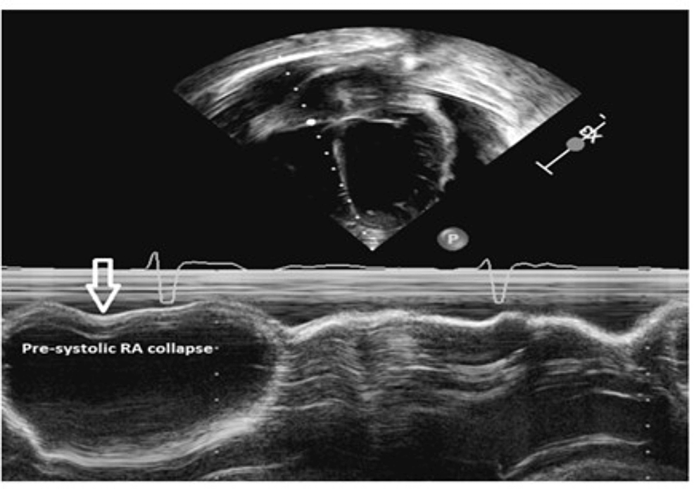 Initial-echocardiography-showing-the-pre-systolic-right-atrial-collapse