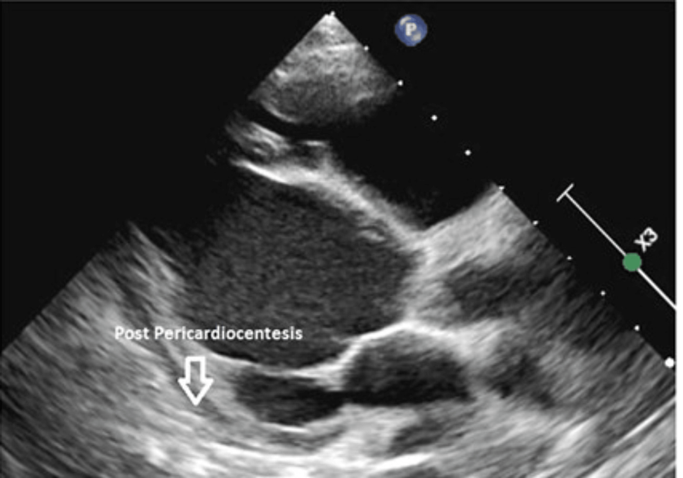 Immediate-post-pericardiocentesis-showing-no-pericardial-collection