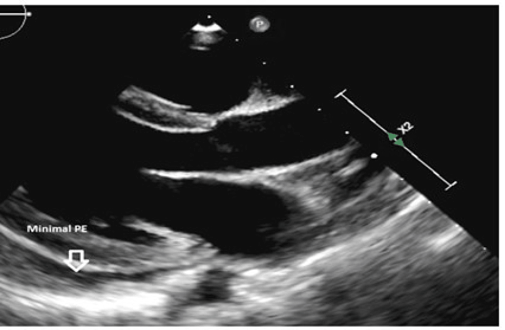 Two-weeks-post-pericardiocentesis-showing-minimal-pericardial-recollection