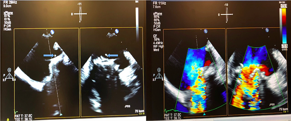 (Left)-Mobile-friable-vegetations-arising-from-the-mitral-prosthetic-valve.-(Right)-Severe-mitral-regurgitation-with-torrential-back-flow-across-the-prosthetic-mitral-valve-demonstrated-by-Colour-Doppler.