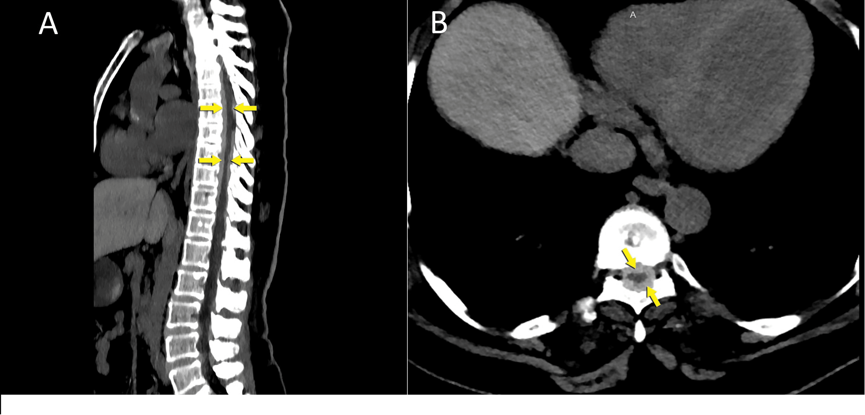 A Hypertrophic Spinal Pachymeningitis Patient With Factor V Leiden