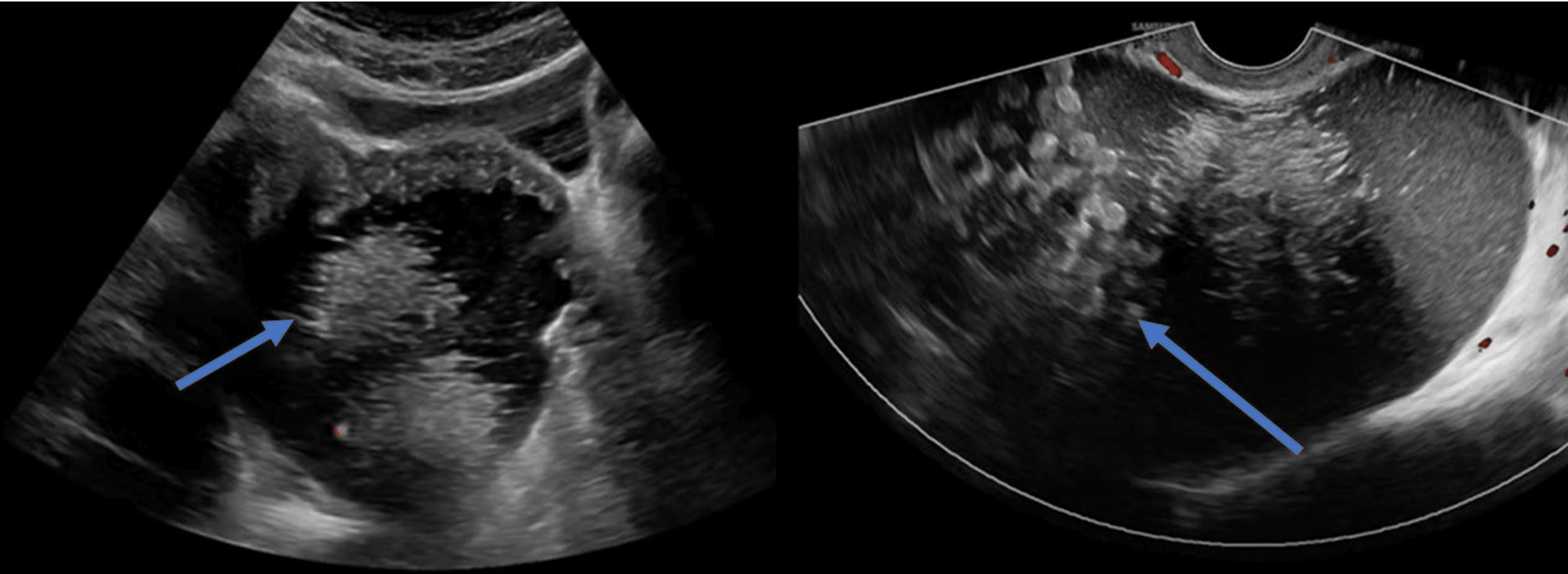 Cureus Dermoid Cyst Spillage Resulting In Chemical Peritonitis A Case Report And Literature 1931