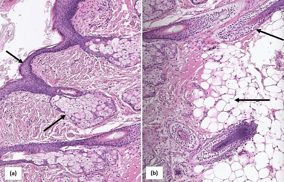 Cureus Dermoid Cyst Spillage Resulting In Chemical Peritonitis A Case Report And Literature 9530