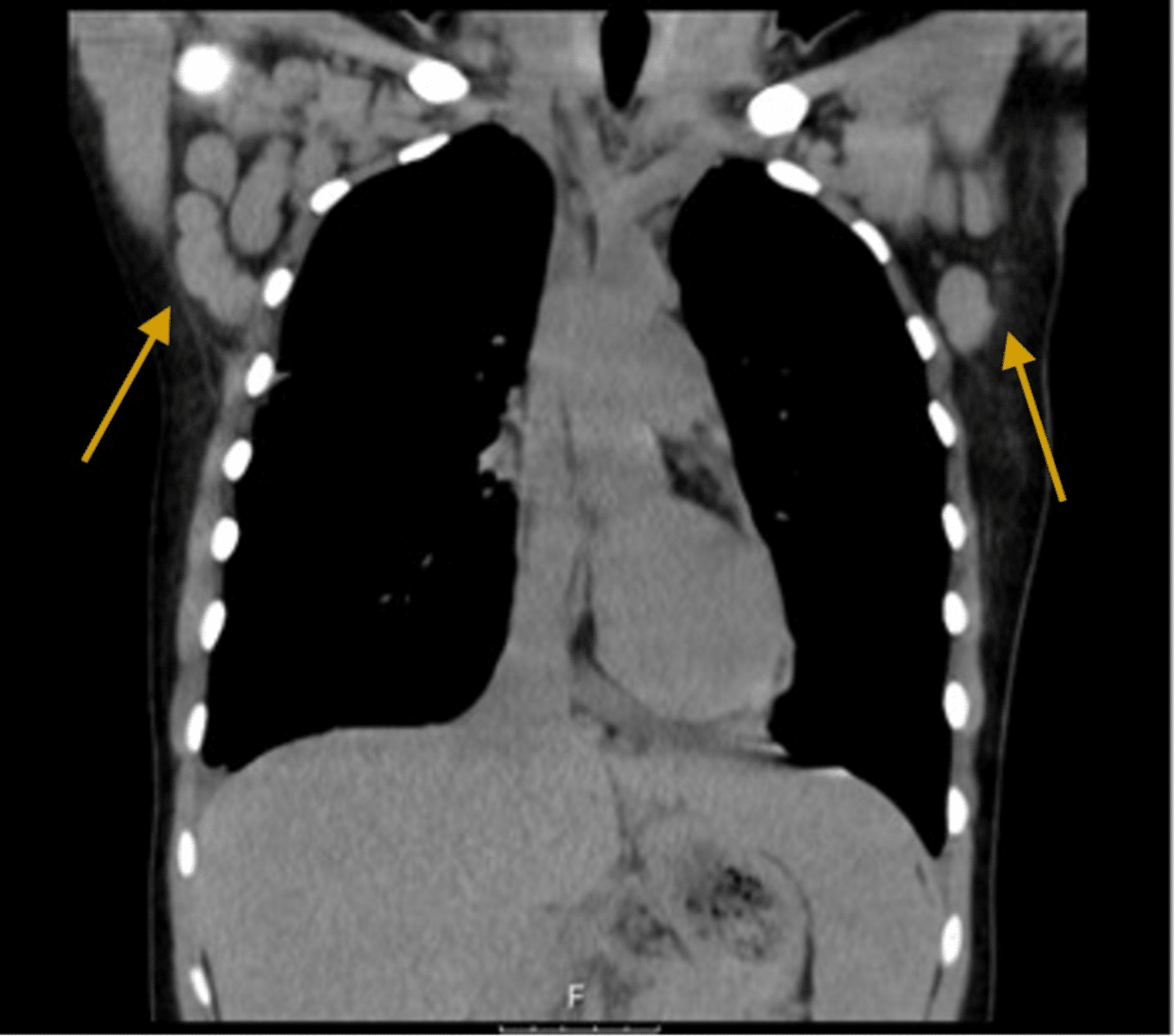 cureus-generalized-lymphadenopathy-as-the-first-manifestation-of