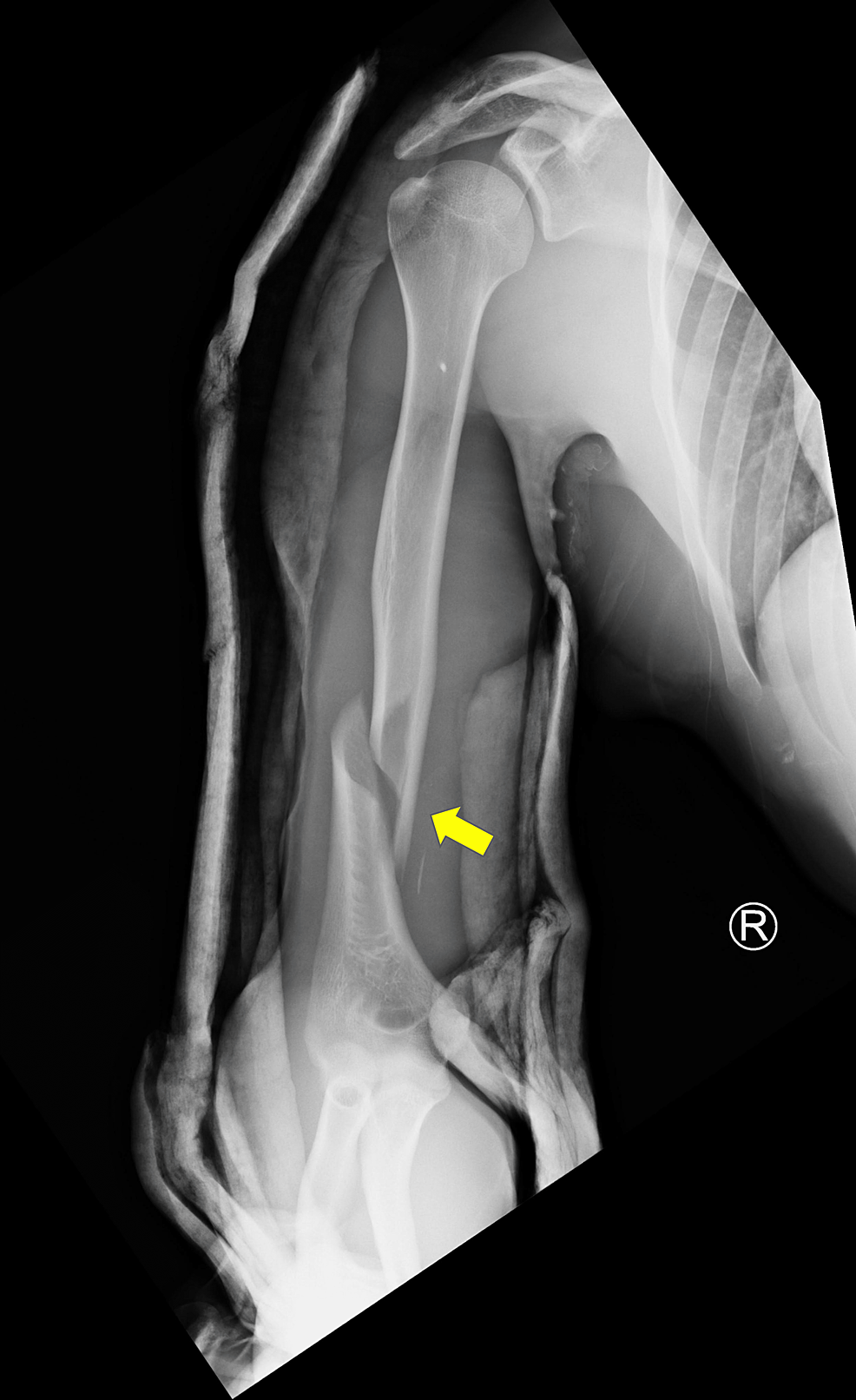 surgical humerus of arm