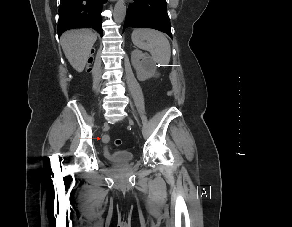 Cureus Primary Ureteral Stump Carcinoma Rare Presentation and Management