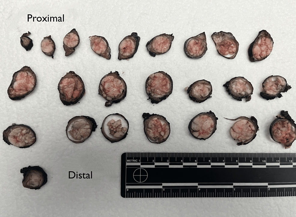 Cureus Primary Ureteral Stump Carcinoma Rare Presentation and Management