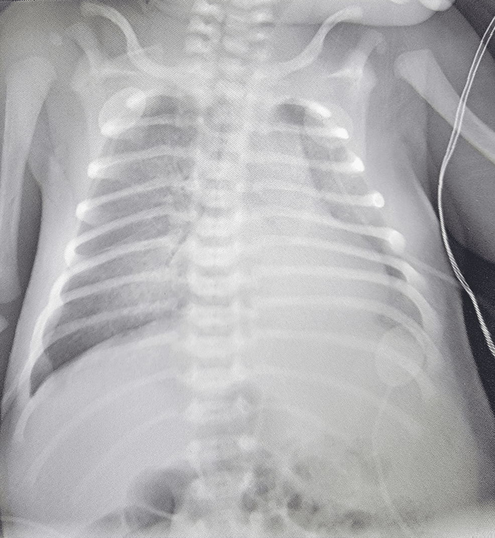 Cureus Gastroesophageal Reflux Disease In A One Week Old Infant 