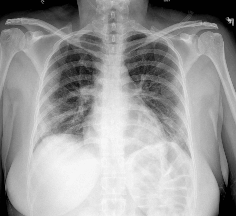 Chest-x-ray-of-a-44-year-old-female-with-COVID-19-viral-pneumonia