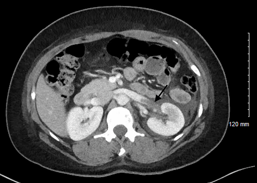 Computed-tomography-(CT)-abdomen-and-pelvis-with-contrast-showing-thrombosis-of-the-left-renal-vein-(arrow)